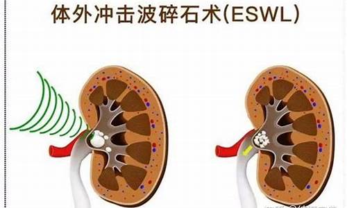 上尿路结石体外冲击波碎石图片(上尿路结石治疗原则)_https://www.xzdzcjn.com_上交所_第1张